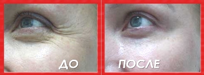 Предлагаем: Мезотерапия